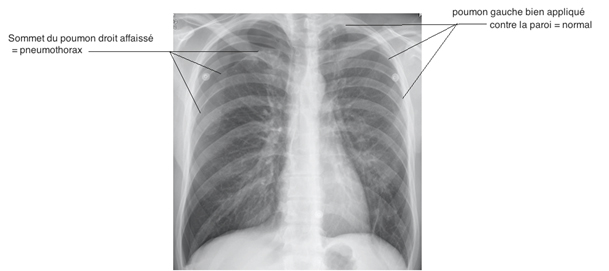 Pneumothorax1