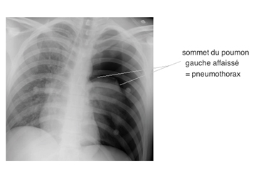 b- Pneumothorax gauche vu à la radio 