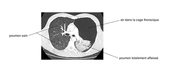 c- Même patient qu’en (b) = pneumothorax gauche vu au scanner.