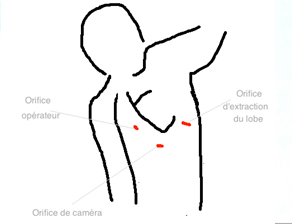 Pneumothorax4