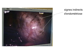 Photo : Vue en vidéothoracoscopie de la coupole diaphragmatique : on voit bien les trous laissés par les nodules desquamés d’endométriose, et au- travers desquels on peut apercevoir le foie sous- jacent (de couleur violette).